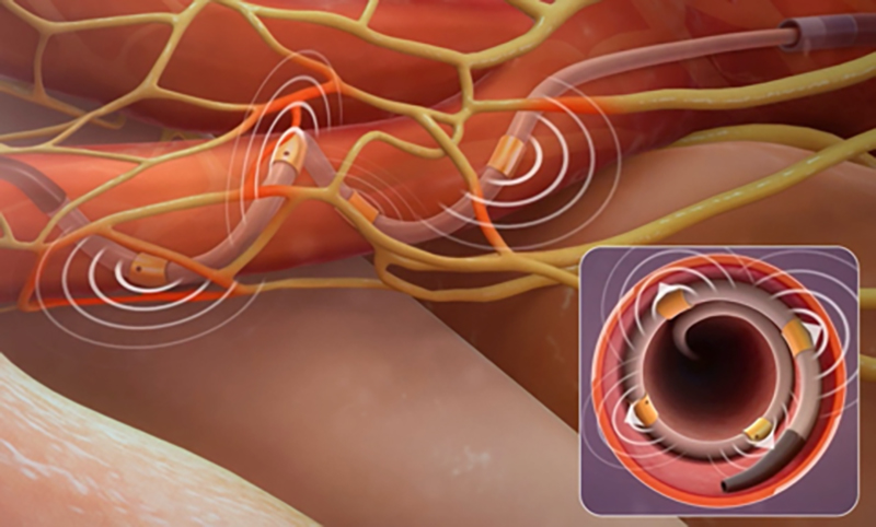 Denervazione Renale: Innovazione nel Trattamento dell’Ipertensione Arteriosa