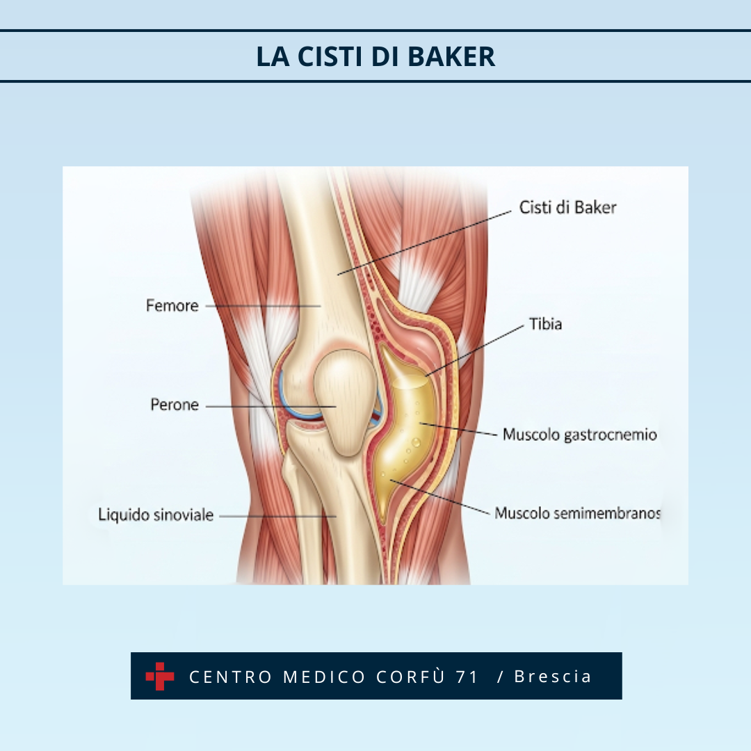 CISTI DI BAKER