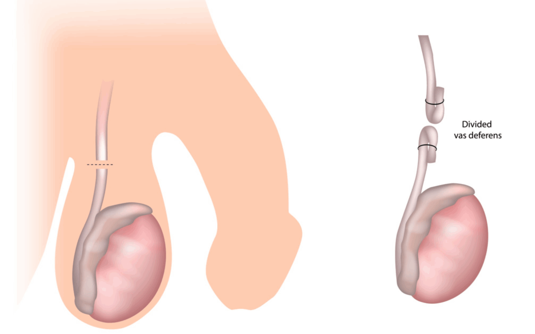 LA VASECTOMIA