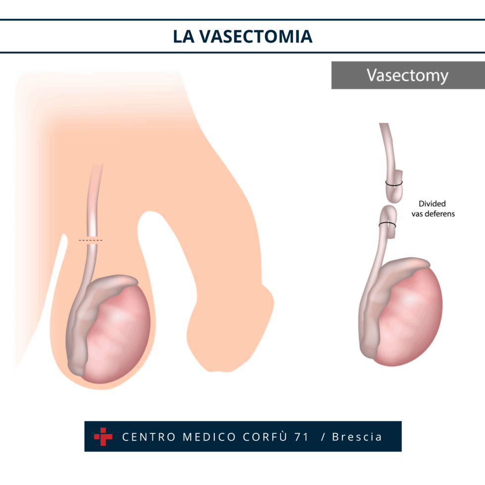 LA VASECTOMIA