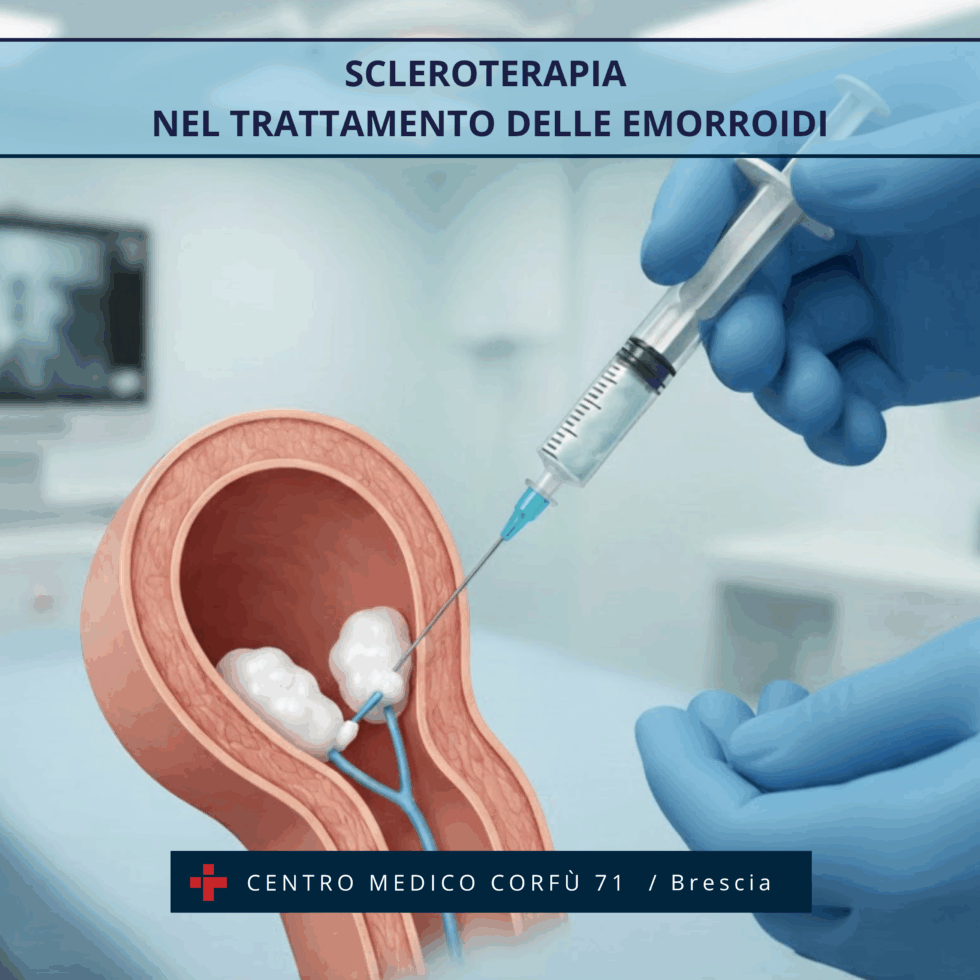 SCLEROTERAPIA NEL TRATTAMENTO DELLE EMORROIDI