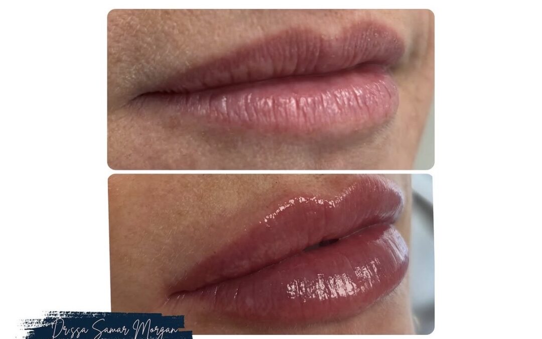 FILLER LABBRA CON ACIDO IALURONICO: TUTTO QUELLO CHE DEVI SAPERE!