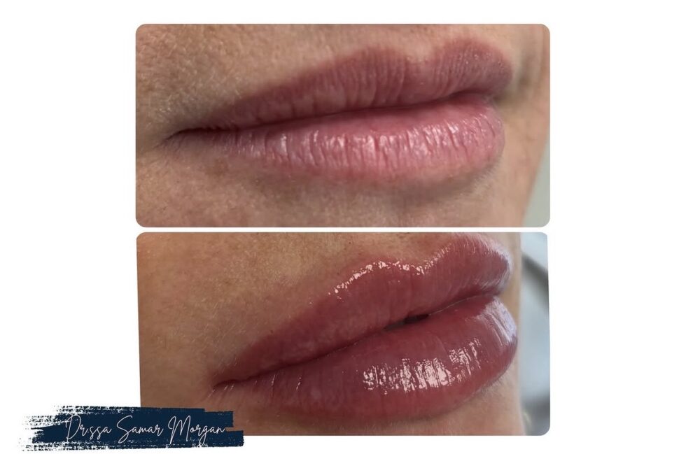 FILLER LABBRA CON ACIDO IALURONICO: TUTTO QUELLO CHE DEVI SAPERE!