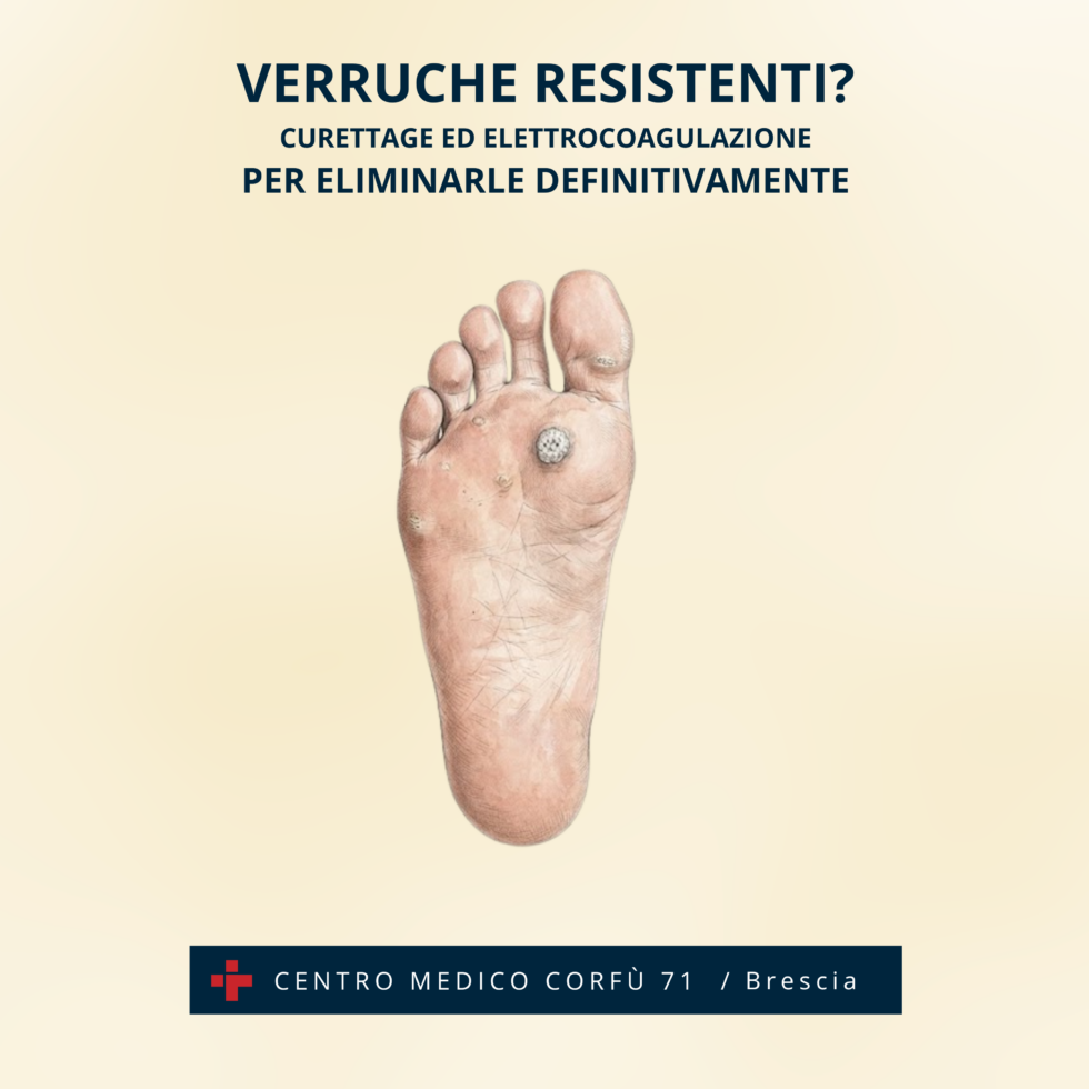 ADDIO ALLE VERRUCHE RESISTENTI!